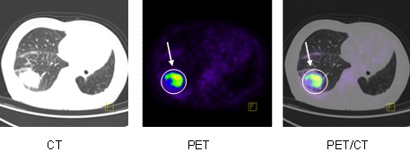 A Cardio-CT és a PET/CT életet menthet!