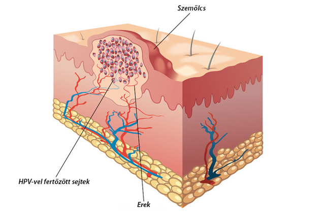 mik a szemölcsök a nemi szemölcs puhatestű papillómájában
